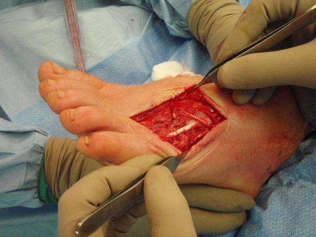 clean-as-a-whistle-and-5th-toe-tendon-good clean-as-a-whistle-and-5th-toe-tendon-good