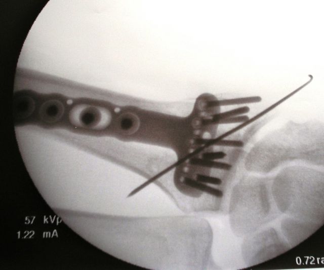 xray-hand xray-hand