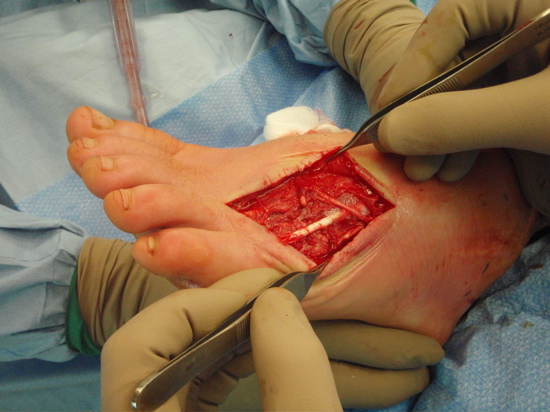 clean-as-a-whistle-and-5th-toe-tendon-good